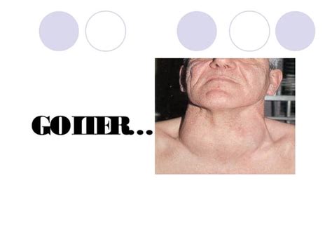 Goiter Anatomy And Physiology Ppt