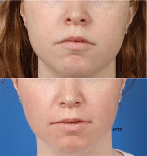 Buccal Fat Removal New York City Gotham Plastic Surgery