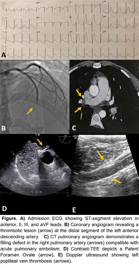Simultaneous Pulmonary Embolism And Paradoxical St Elevation Myocardial