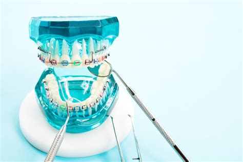 Rubber Bands For Braces Helpful Tips And Tricks