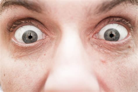 Ojos Saltones O Exoftalmia Síntomas Y Tratamiento Blog De Clínica