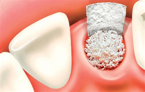 O Que é O Enxerto ósseo Dentário Hospital Da Face