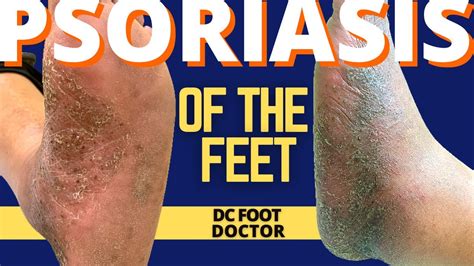 Psoriasis And The Feet Part 2 Treating Pustular Psoriasis Of The Skin Youtube