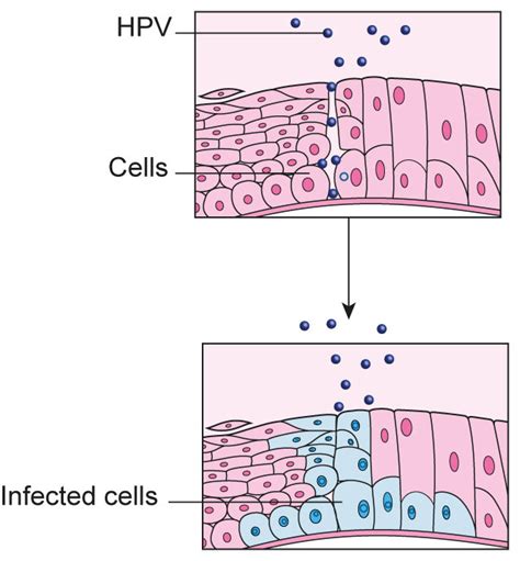 For most women the hpv infection does not last long; Infectia cu HPV (Human Papilloma Virus) - How hpv causes ...