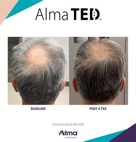 Alma Ted Laser Hair Restoration For Men At Htandrc