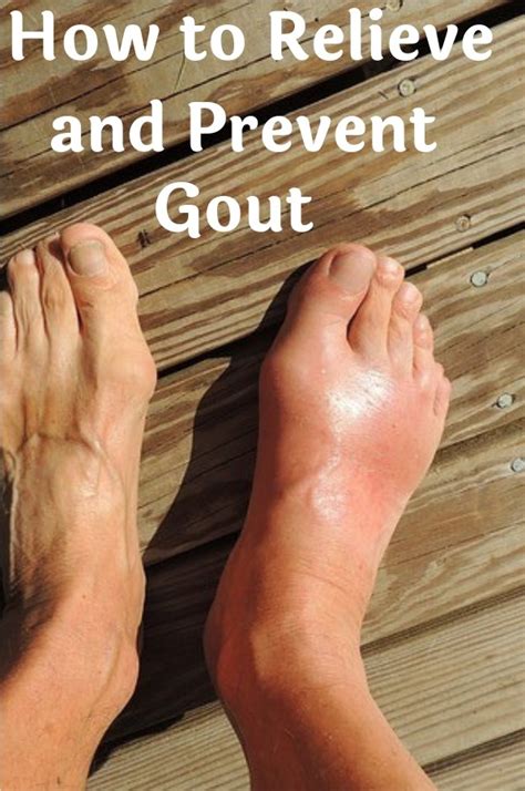 Healthy Food And Life How To Relieve And Prevent Gout
