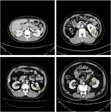 Example Results Of Renal Mass Segmentation In Four Patients Red