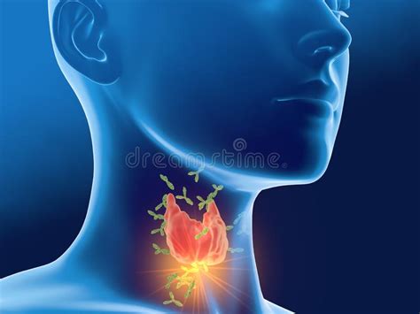 Anticorpos Que Atacam A Glndula De Tiroide De Uma Mulher Thyroiditis