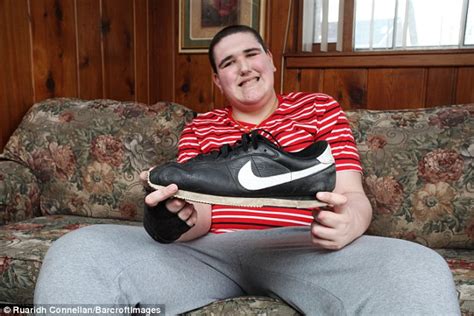 Teenager With Gigantism Reaches A Record Breaking 7ft 8in Daily Mail