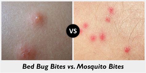 Read About Bed Bug Bites Top Pestcontrolsg