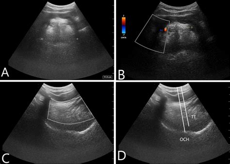Cureus Role Of Submandibular Ultrasound In Airway Management Of A