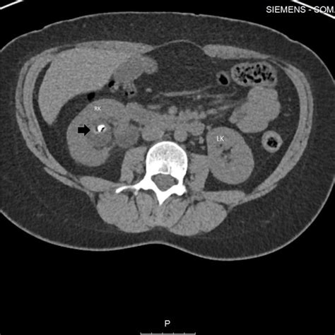Enhanced Axial A Ct Scan Of The Abdomen At The Level Of The Kidneys