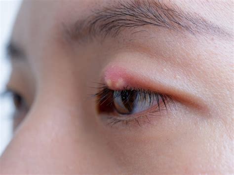 Itchy Bump On Eyelid Causes Types And Prevention