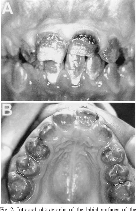 Get the facts before you buy. PDF Oral and dental manifestations of vitamin D ...