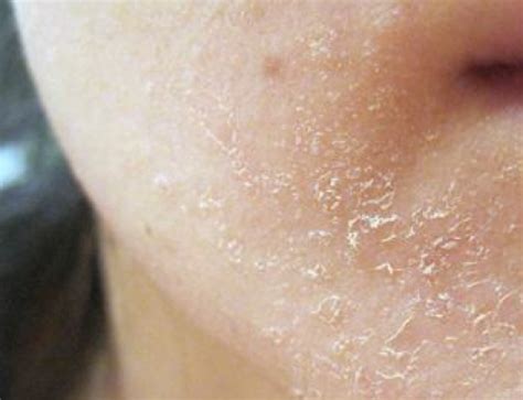 Dry Skin On Face 500x383 Born Realist