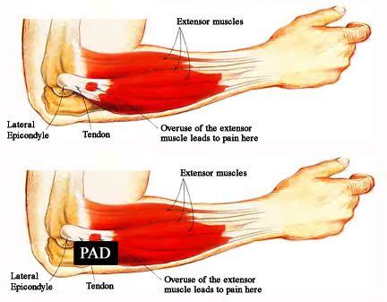 The upper arm is located between the shoulder joint and elbow joint. tennis elbow diagrams - Google Search | Tennis elbow, How ...