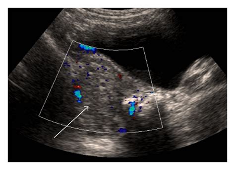 Doppler Ultrasound Of A Large Right Ovarian Cyst Estimated Ovarian