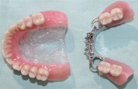 Difference Between Cast Partial Denture And Removable Partial Denture