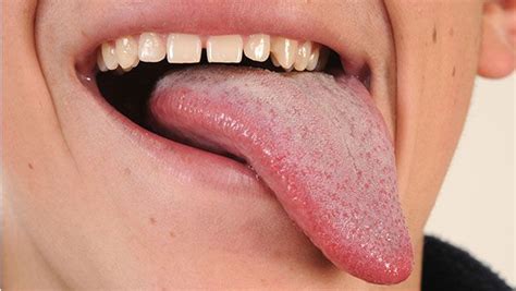 White Coating With Red Spots On Tongue What Are The Treatments
