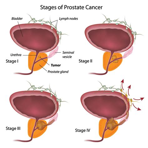 Staging Of Prostate Cancer Net Health Book