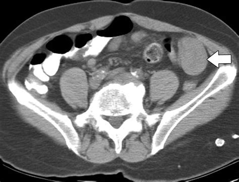 Adult Intestinal Intussusception Ct Appearances And Identification Of