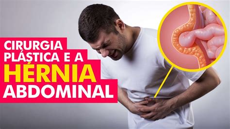 Cirurgia Plástica E A HÉrnia Abdominal Parede Abdominal Tire Suas