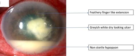 Mycotic Fungal Corneal Ulcer New