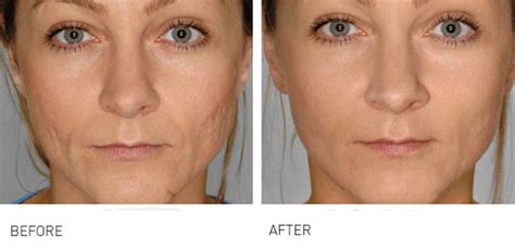 Anita East Lower Face Rejuvenation Revitalise The Chin