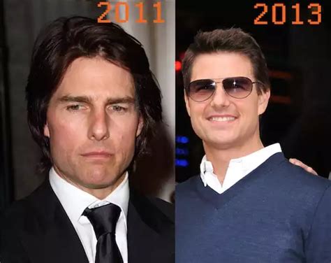 Is Tom Cruise Opting For Plastic Surgery Cosmetic Town