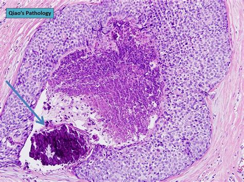 Qiaos Pathology Microcalcifications In Malignant Breast Flickr
