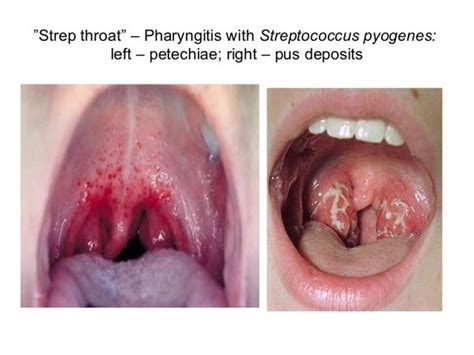 Prior To Antibiotics Did Most People Die From Small Infections Like