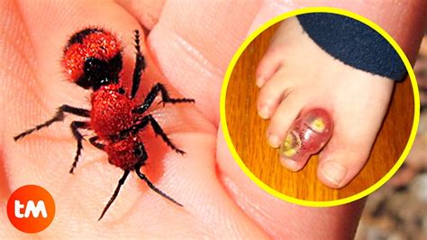 The Worst Insect Bites In The World 😫🐝 Youtube