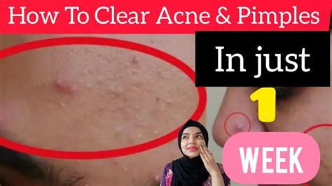 How To Remove Acne And Pimples Acne Treatment At Home 3 Days Acne