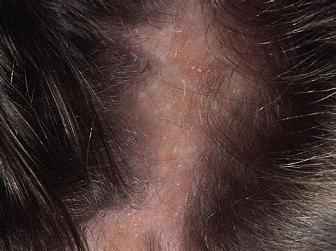 Infectious Diseases Of Scalp And Hair Ponirevo