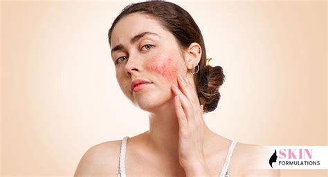 Skin Redness Types Causes Treatments And Home Remedies