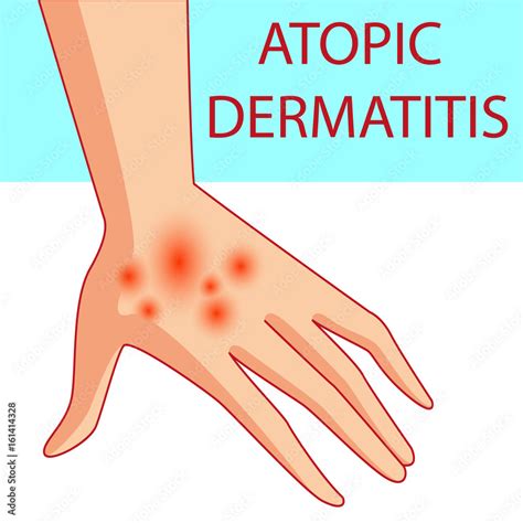 Atopic Dermatis The Person Scratches The Arm On Which Is Atopic