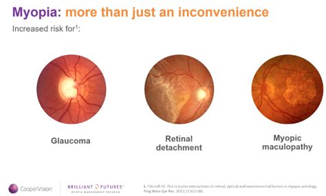 Myopia Management Golden Eyes Optometry