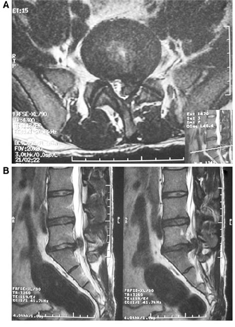 Although many patients are diagnosed with a lower back and/or sciatica pain syndrome based on an l5/s1 pathology, this diagnosis is sometimes wrong, leading to the common occurrence of misdiagnosed herniated. T2W MRI axial (a) and para-sagittal images (b) showing a left herniated... | Download Scientific ...