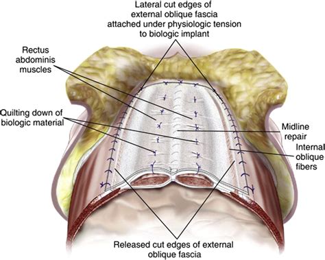 Open Ventral Hernia Repair With Component Separation Surgical Clinics