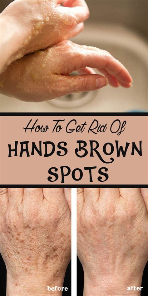 How To Get Rid Of Hands Brown Spots Dicas De Beleza Dicas De Saúde