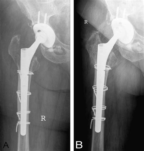 A B A Postoperative Fracture Of The Greater Trochanter Is Shown A A