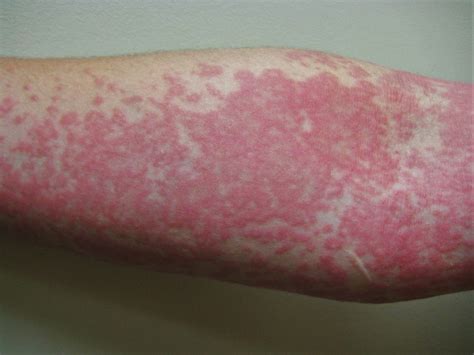Skin Rashes And Their Causes
