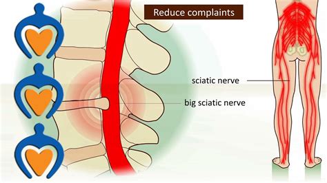 Lower Back Pain A O Sciatica Herniated Disk It S Causes Symptoms
