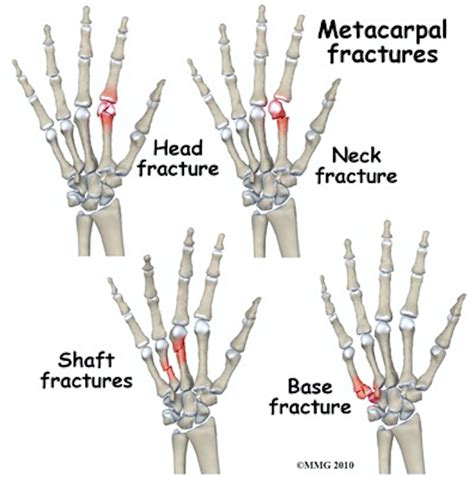 Metacarpal Fracture Symptoms Fundnery