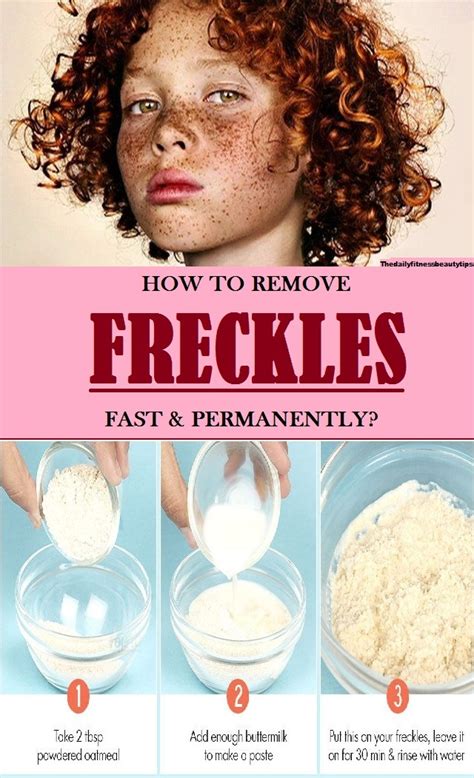 How To Remove Freckles Fast And Permanently At Home