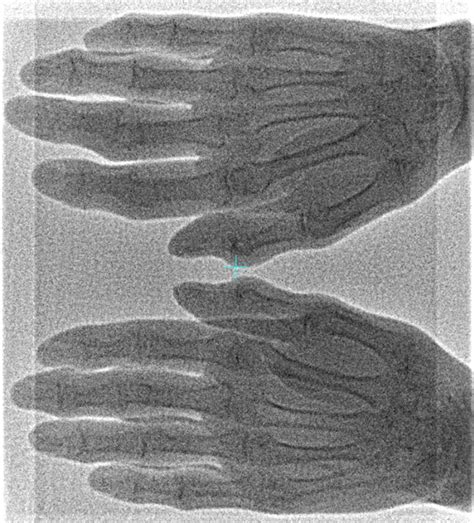 Portal Imaging Of Radiotherapy For Osteoarthritis Of Multiple Finger