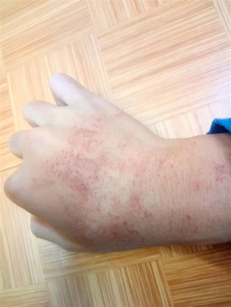 Winter Rash On Hands Eczema Atopic Dermatitis Symptoms Causes