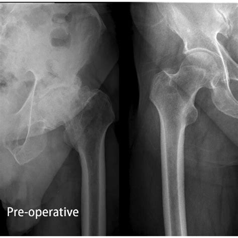 Preoperative And Postoperative Radiographs Of Total Hip Arthroplasty