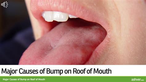 Tiny Bumps On Mouth Roof Terrifying Dark Mark Inside Baby S Mouth