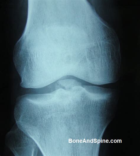 Tibial plateau fractures signify periarticular fractures of the proximal tibia frequently associated with soft tissue injuries. Knee Injuries Xrays and Clinical Photographs | Bone and Spine